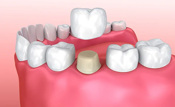 Dr. Shvarts gives you the smile of your dreams