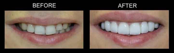 Philadelphia Dentist Smile Design